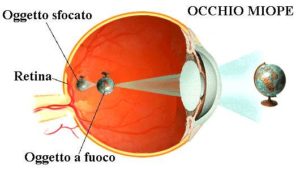 laser per la miopia