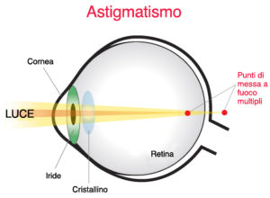 curare astigmatismo