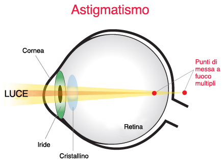 curare astigmatismo