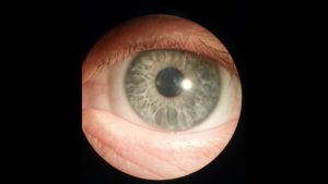 diagnosi cheratocono