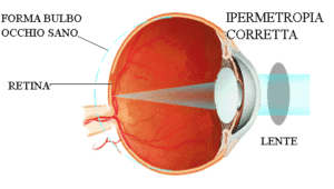 ipermetropia occhi