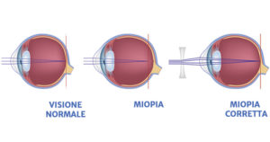 correzione miopia con laser