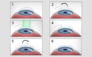 correzione miopia laser