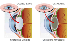 intervnti di cataratta