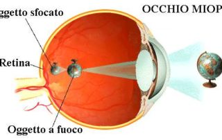 laser per la miopia